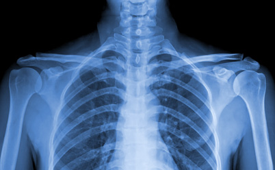 röntgen a tüdőről ascarisszal